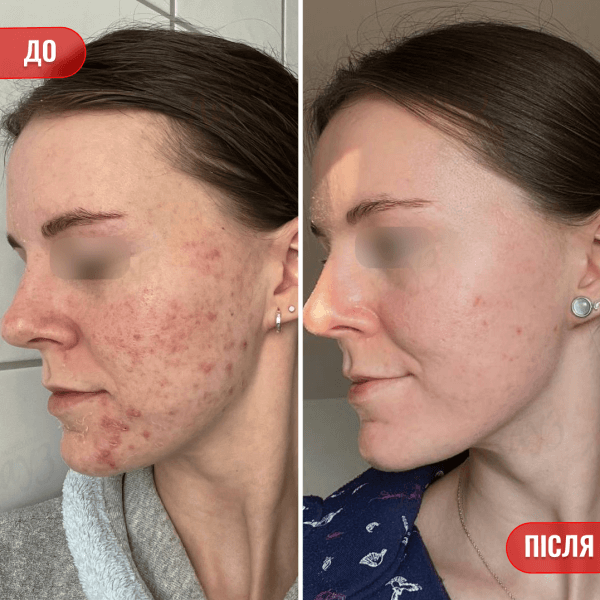 НАШІ РЕЗУЛЬТАТИ ДО ТА ПІСЛЯ