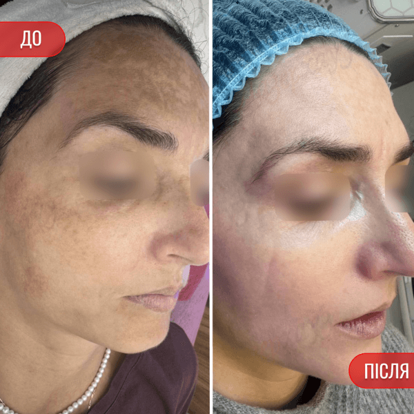 НАШІ РЕЗУЛЬТАТИ ДО ТА ПІСЛЯ