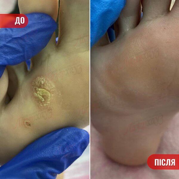 НАШІ РЕЗУЛЬТАТИ ДО ТА ПІСЛЯ