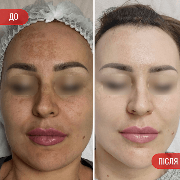 НАШІ РЕЗУЛЬТАТИ ДО ТА ПІСЛЯ