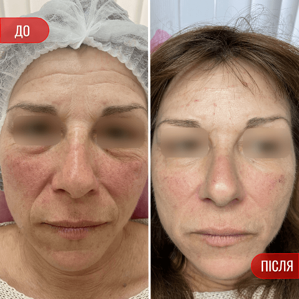 НАШІ РЕЗУЛЬТАТИ ДО ТА ПІСЛЯ