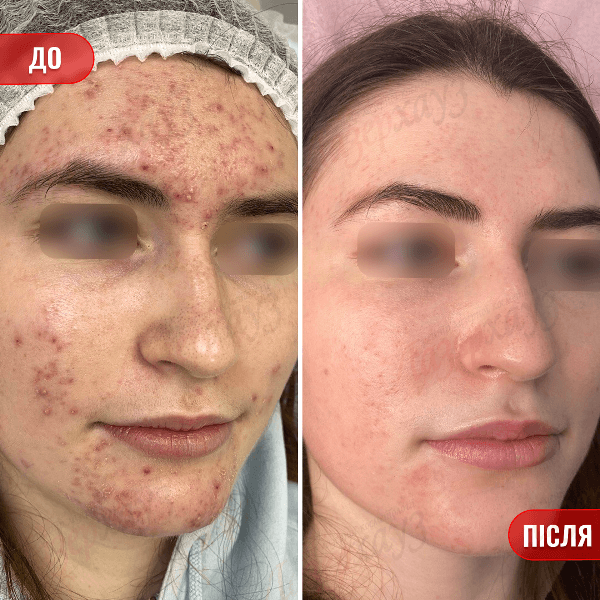 НАШІ РЕЗУЛЬТАТИ ДО ТА ПІСЛЯ