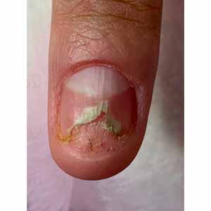 Лазерное лечение грибка ногтей