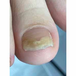 Грибок ногтей на ногах. Рекомендации дерматолога для лечения в домашних условиях!