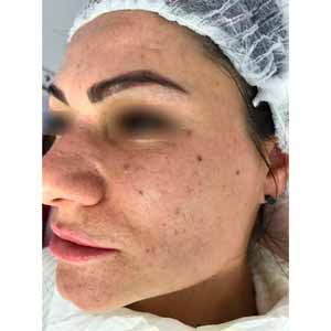 Неровная кожа на лице: выравнивание рельефа кожи у косметолога и дома